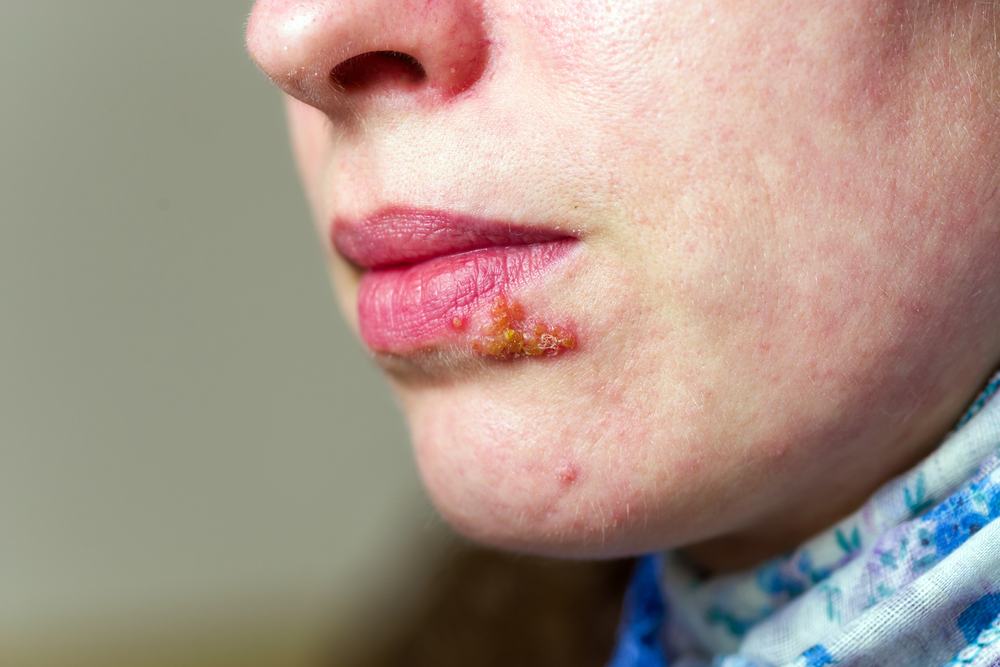 Herpes