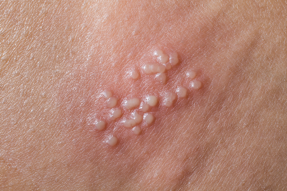 Herpes